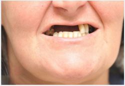 5 HẬU QUẢ NGHIÊM TRỌNG CỦA VIỆC MẤT RĂNG LÂU NGÀY