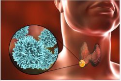 4 DẤU HIỆU CẦN BIẾT CỦA U LÀNH TUYẾN GIÁP VÀ GIẢI PHÁP ĐIỀU TRỊ HIỆU QUẢ