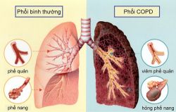 Ðể kiểm soát tốt bệnh phổi tắc nghẽn mạn tính - Bệnh viện Bạch Mai