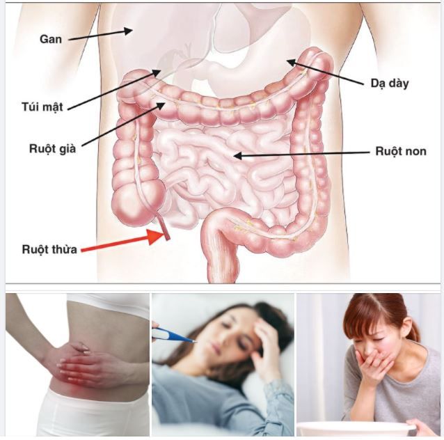 3 BIẾN CHỨNG NGHIÊM TRỌNG CỦA VIÊM RUỘT THỪA