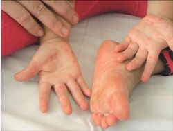 3 DẤU HIỆU TRẺ BỊ TAY CHÂN MIỆNG THỂ NẶNG