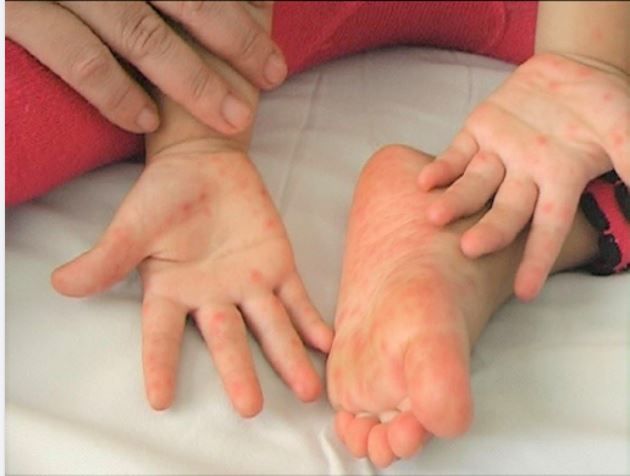 3 DẤU HIỆU TRẺ BỊ TAY CHÂN MIỆNG THỂ NẶNG
