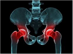 4 nguyên nhân phổ biến dẫn đến việc phải thay khớp háng