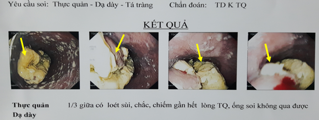 Phối hợp hóa chất, xạ trị gia tốc chiếu ngoài và xạ trị áp sát suất liều cao trong điều trị ung thư - Bệnh viện Bạch Mai