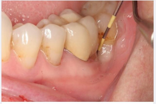 DẤU HIỆU VÀ PHƯƠNG PHÁP ĐIỀU TRỊ VIÊM QUANH CUỐNG RĂNG