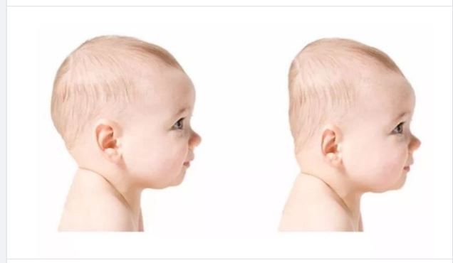 TRẺ BỊ HỘI CHỨNG ĐẦU PHẲNG, MẸ ĐÃ BIẾT HẾT CÁC NGUYÊN NHÂN?