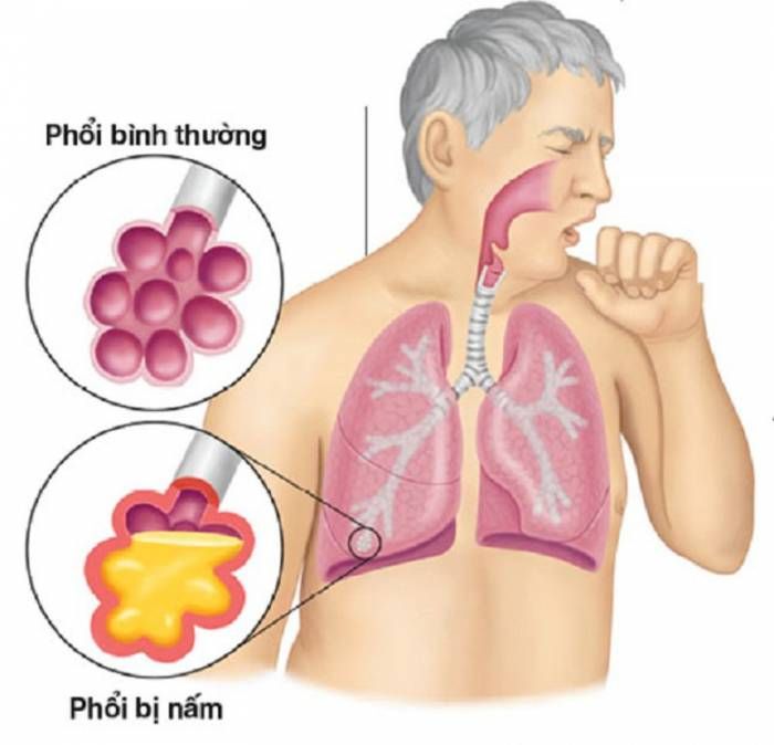 Nấm phổi - căn bệnh nguy hiểm ít người biết - Bệnh viện Bạch Mai
