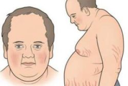 Hội chứng Cushing - Bệnh viện Nội Tiết trung ương