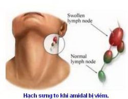 Viêm amidal và cách xử lý - Bệnh viện Bạch Mai