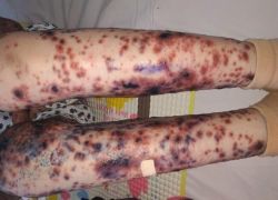 Bé gái Việt mang căn bệnh hiếm, cả thế giới chỉ có 38 trẻ mắc - Bệnh viện Bạch Mai