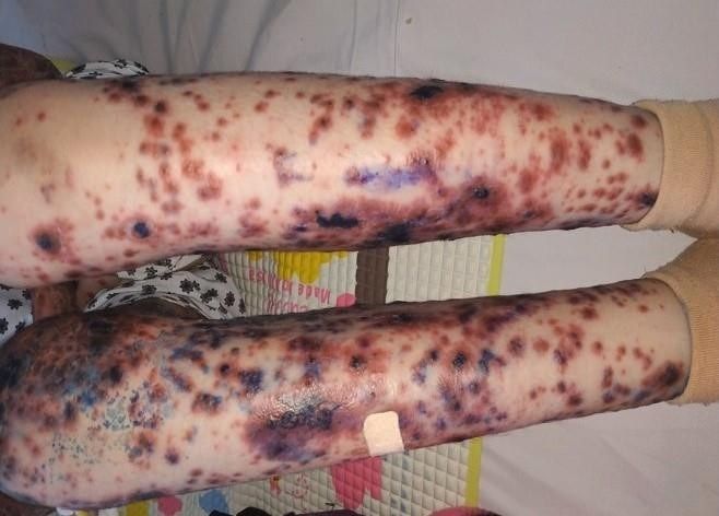 Bé gái Việt mang căn bệnh hiếm, cả thế giới chỉ có 38 trẻ mắc - Bệnh viện Bạch Mai