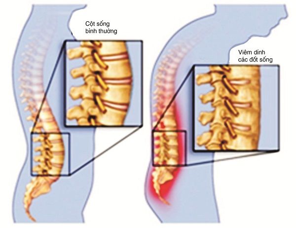 Bệnh viêm cột sống dính khớp - Bệnh viện Bạch Mai