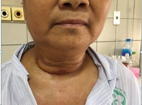 CẮT KHỐI U TRUNG THẤT KHỔNG LỒ NẰM TRONG LỒNG NGỰC  BỆNH NHÂN GẦN 10 NĂM - Bệnh viện Bạch Mai