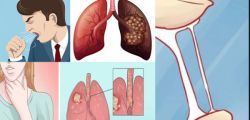 Bộ Y tế ban hành tài liệu chuyên môn "Hướng dẫn chẩn đoán và điều trị ung thư phổi không tế bào nhỏ" - Bệnh viện Bạch Mai
