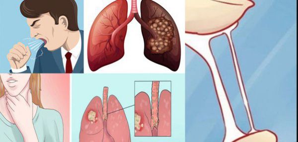 Bộ Y tế ban hành tài liệu chuyên môn "Hướng dẫn chẩn đoán và điều trị ung thư phổi không tế bào nhỏ" - Bệnh viện Bạch Mai