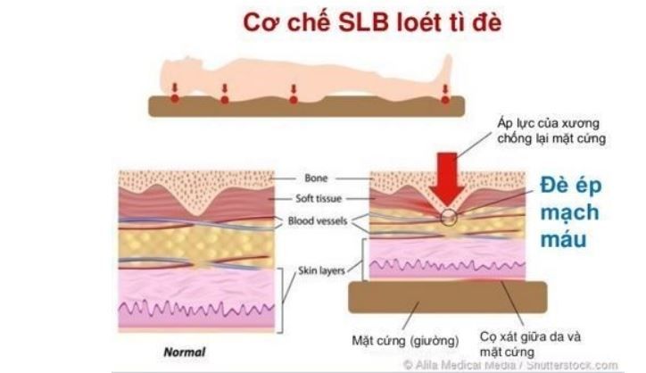 Chế độ dinh dưỡng phòng loét do tì đè - bệnh viện Việt Đức