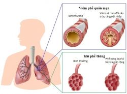 Ứng dụng tế bào gốc trong điều trị bệnh phổi tắc nghẽn mạn tính - Bệnh viện Bạch Mai