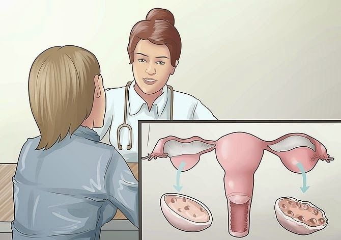 Nguy hại của bệnh đa nang buồng trứng - Bệnh viện Bạch Mai