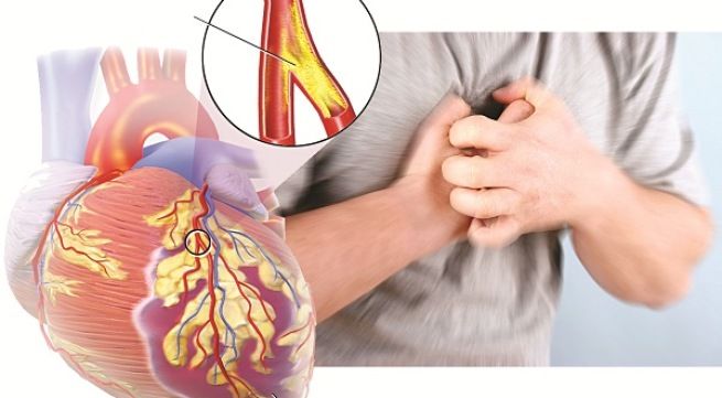 Dấu hiệu sớm của bệnh động mạch vành - Bệnh viện Bạch Mai