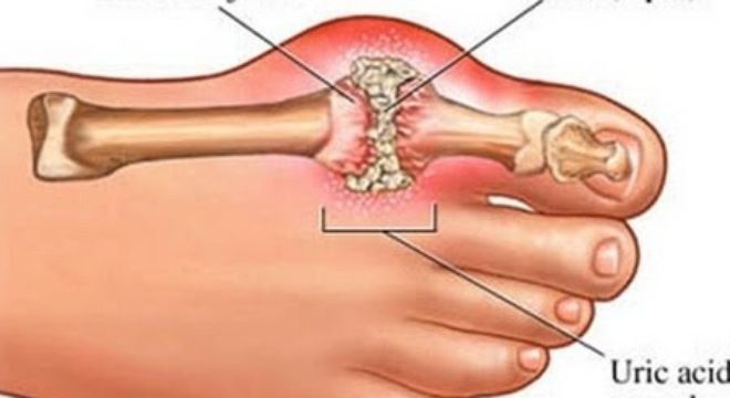Biến chứng kinh khủng của bệnh gút nhiều người mắc do chủ quan - Bệnh viện Bạch Mai