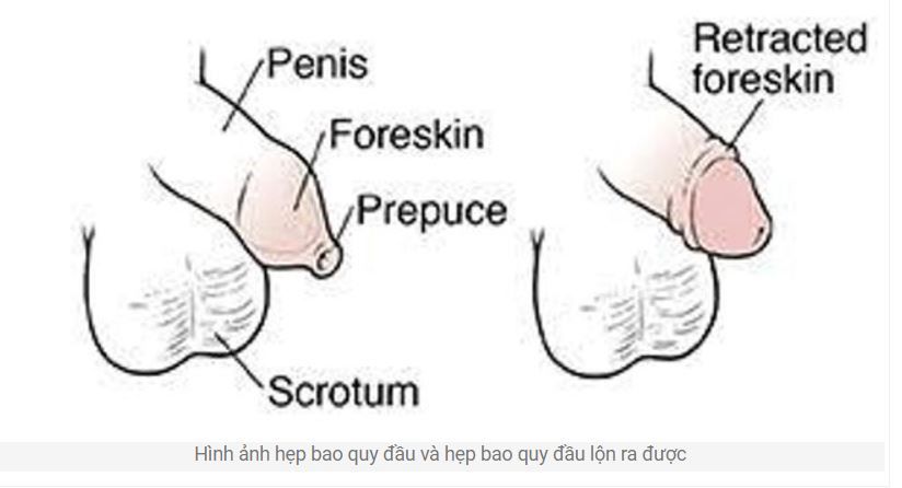 Hẹp bao quy đầu – Khi nào cần cắt bao quy đầu? bệnh viện Việt Đức