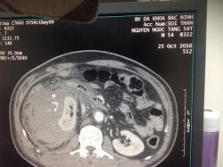 Bệnh nhân bảo tồn được quả thận nhờ kỹ thuật nút mạch - Bệnh viện Bạch Mai