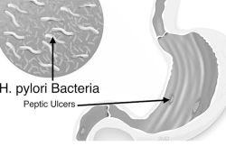 Khi nào vi khuẩn HP gây ung thư dạ dày? - Bệnh viện Bạch Mai