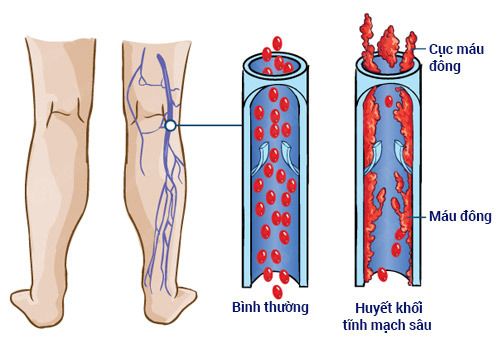 Nhận biết và phòng ngừa thuyên tắc tĩnh mạch sâu - Bệnh viện Bạch Mai