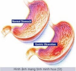 Ung thư dạ dày - Bệnh viện Bạch Mai