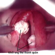 Ung thư thanh quản - Bệnh viện Bạch Mai
