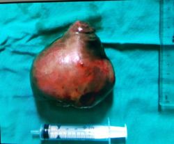 Bật mí phương pháp khiến khối u xơ to như quả bưởi "tự rụng" - Bệnh viện Bạch Mai