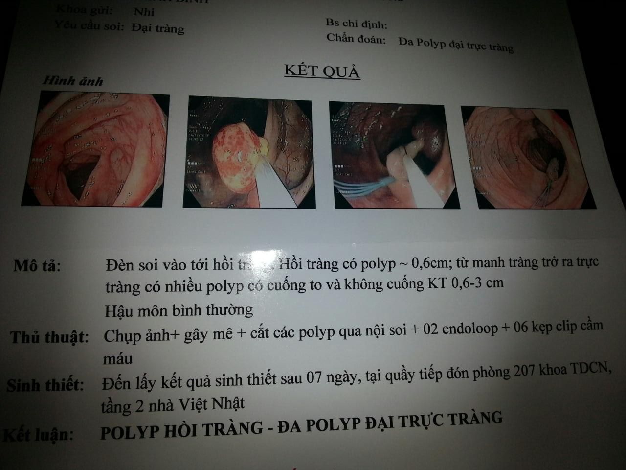 30 polyp đường tiêu hóa ở một bệnh nhi 10 tuổi  đã được phẫu thuật thành công tại BVBM - Bệnh viện Bạch Mai