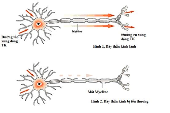Liệt cơ tức thời bởi hội chứng Guillain - Barré - Bệnh viện Bạch Mai