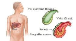 Những dấu hiệu nào cảnh báo bệnh viêm túi mật? - bệnh viện Việt Đức