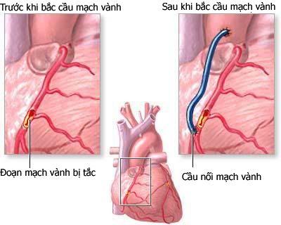 Những nguy cơ gặp phải khi bị cầu cơ động mạch vành - Bệnh viện Bạch Mai
