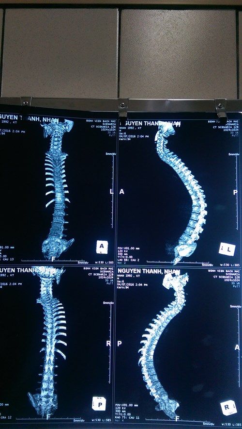 Phẫu thuật chỉnh hình cho bệnh nhân gù nặng - Bệnh viện Bạch Mai