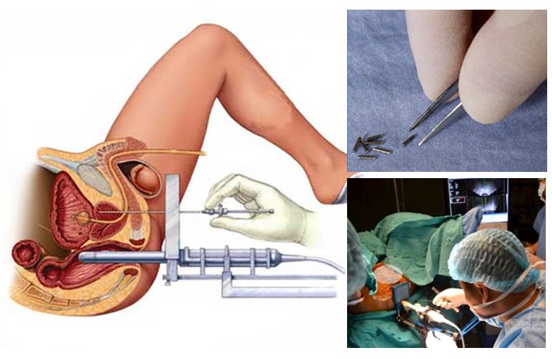 Quy trình cấy hạt phóng xạ điều trị ung thư tuyến tiền liệt - Bệnh viện Bạch Mai