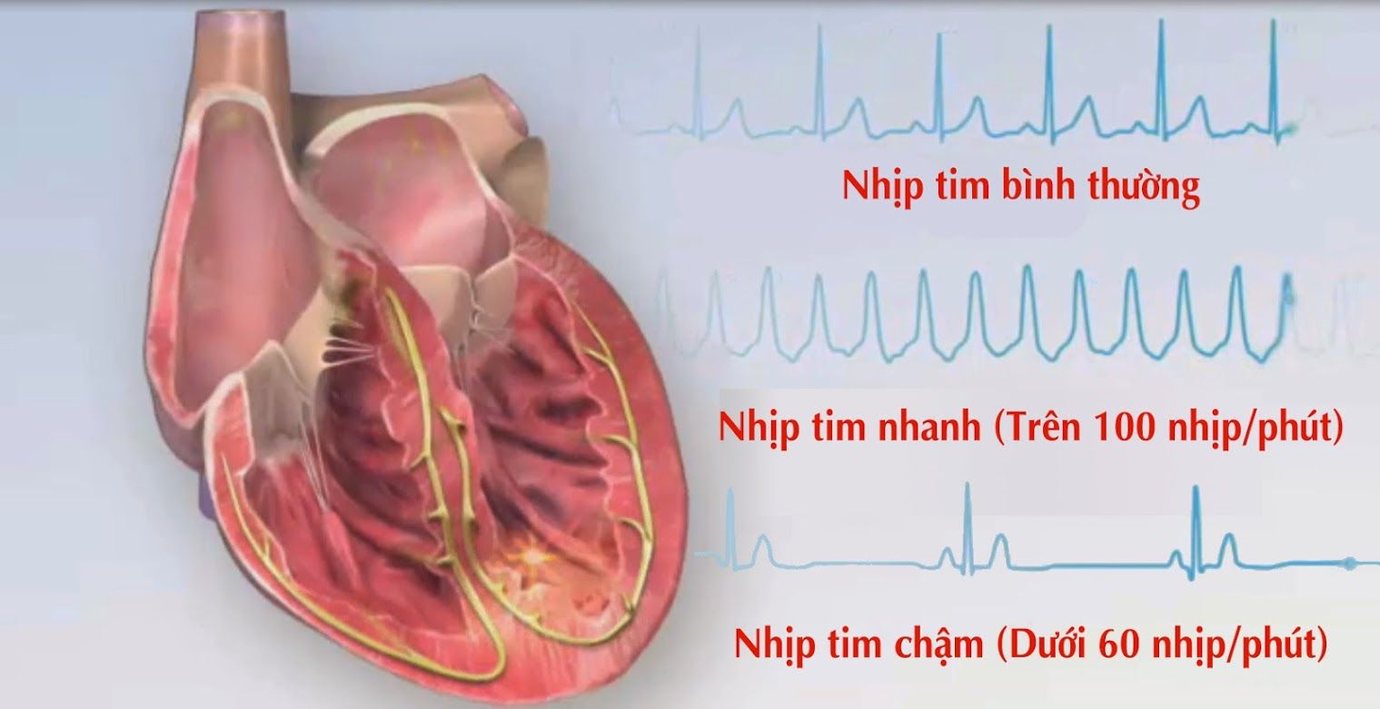 Những hệ lụy khi bị rối loạn nhịp tim - Bệnh viện Bạch Mai