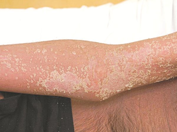 Bệnh xơ cứng bì (Sclerodermie) - Nỗi ám ảnh của người bệnh - Bệnh viện Bạch Mai