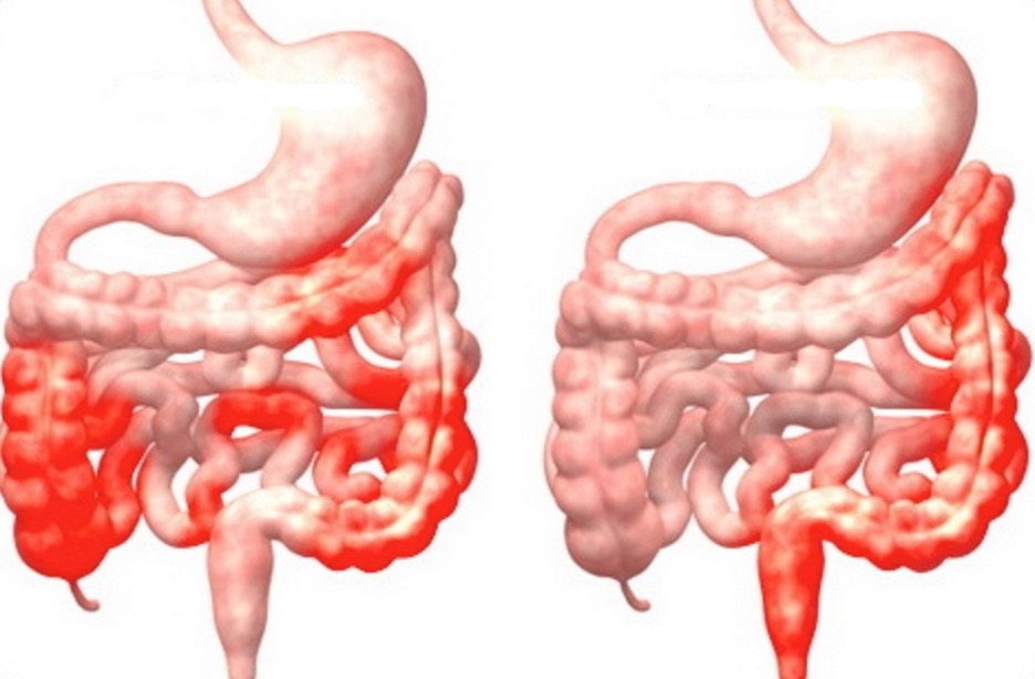 Bệnh Crohn và cách ngừa biến chứng - Bệnh viện Bạch Mai