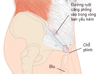 Cách phát hiện và xử trí thoát vị bẹn ở trẻ - Bệnh viện Bạch Mai