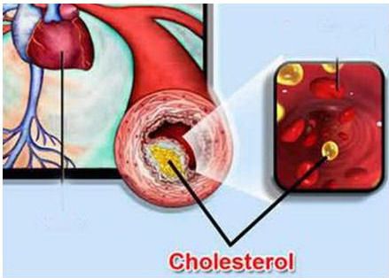 Các yếu tố nguy cơ thường gặp ở bệnh tim mạch - Bệnh viện Bạch Mai