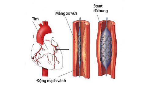 Bệnh động mạch vành ở người cao tuổi - Bệnh viện Bạch Mai