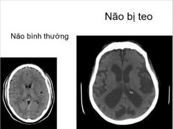 Những nguy hại của rượu tới tâm thần kinh - Bệnh viện Bạch Mai