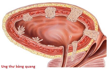 Ung thư bàng quang - Biết sớm, chữa nhanh - Bệnh viện Bạch Mai
