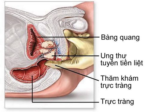 Ung thư tuyến tiền liệt - Ai dễ mắc? - Bệnh viện Bạch Mai