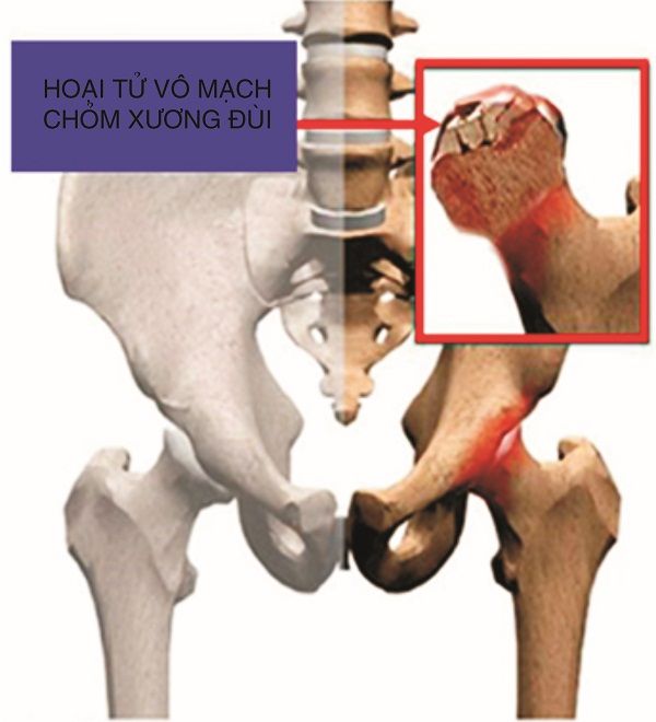 Ứng dụng tế bào gốc trung mô trong chấn thương chỉnh hình - Bệnh viện Bạch Mai