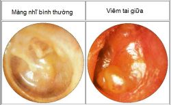 Viêm VA và những biến chứng - Bệnh viện Bạch Mai