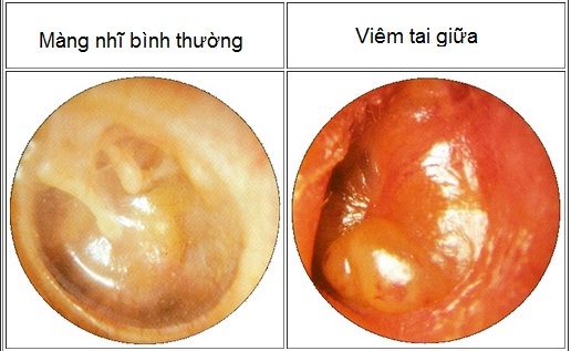 Viêm VA và những biến chứng - Bệnh viện Bạch Mai