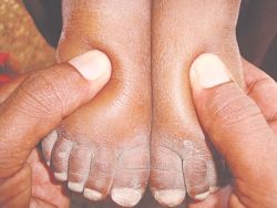 Viêm vi cầu thận cấp - Bệnh viện Bạch Mai